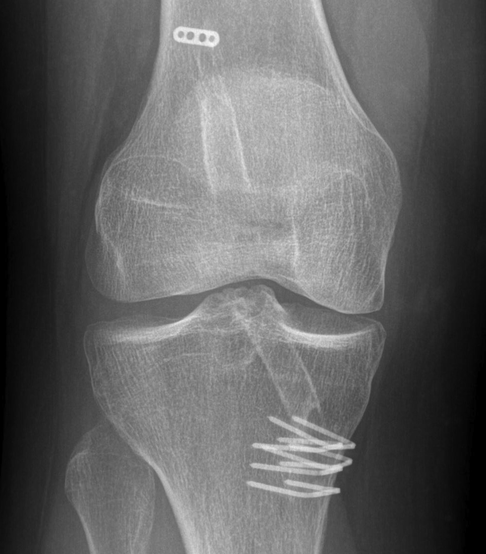 Revision ACL Vertical Femoral Tunnel